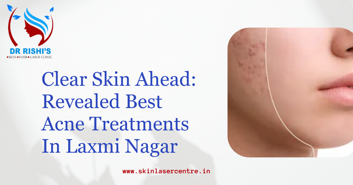 Clear Skin Ahead: Revealed Best Acne Treatments in Laxmi Nagar